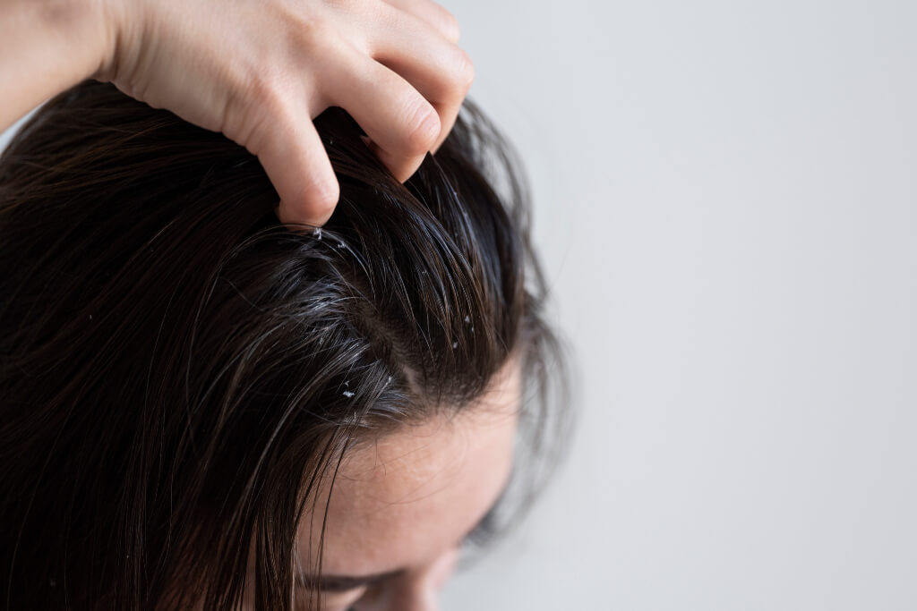 Dermatitis seborreica y alopecia: ¿existe relación?